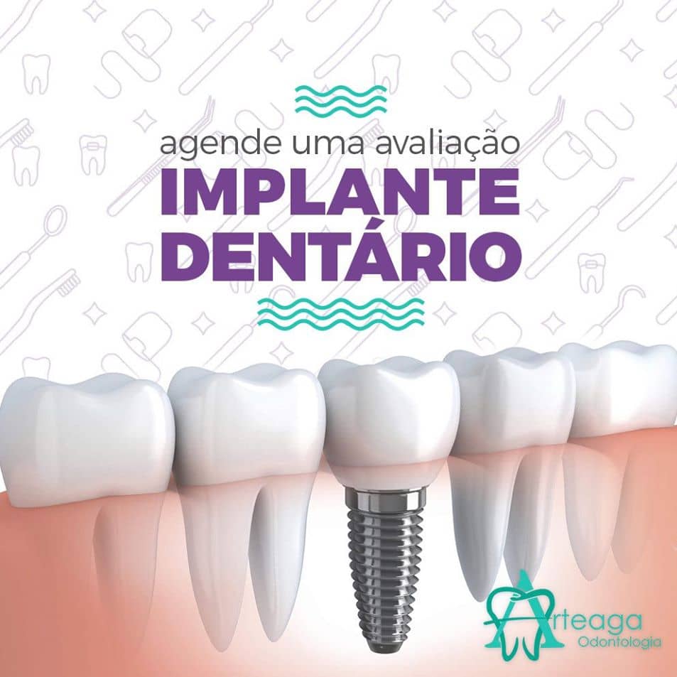 Implante Dentário