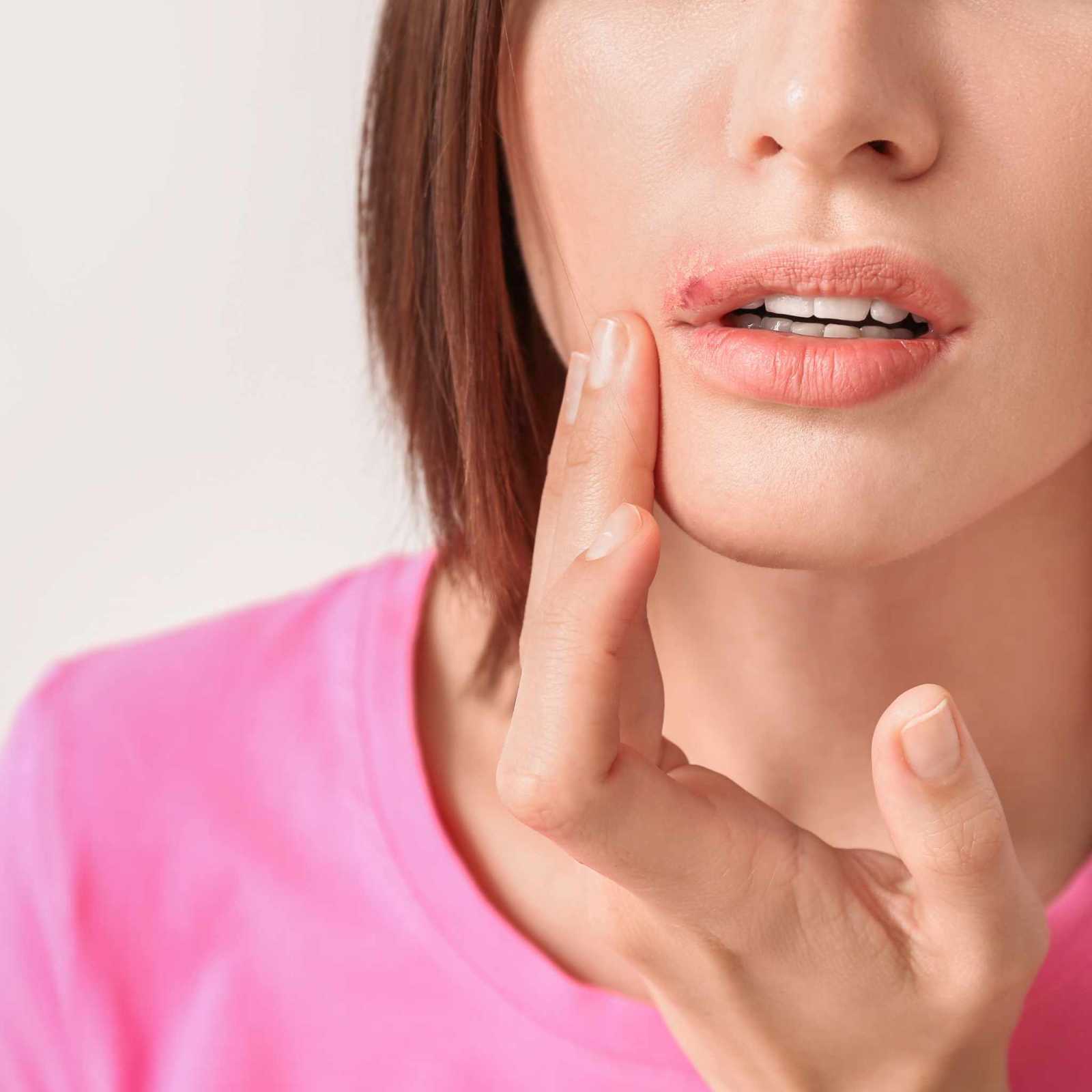 Herpes Labial - Tratamento em Joinville