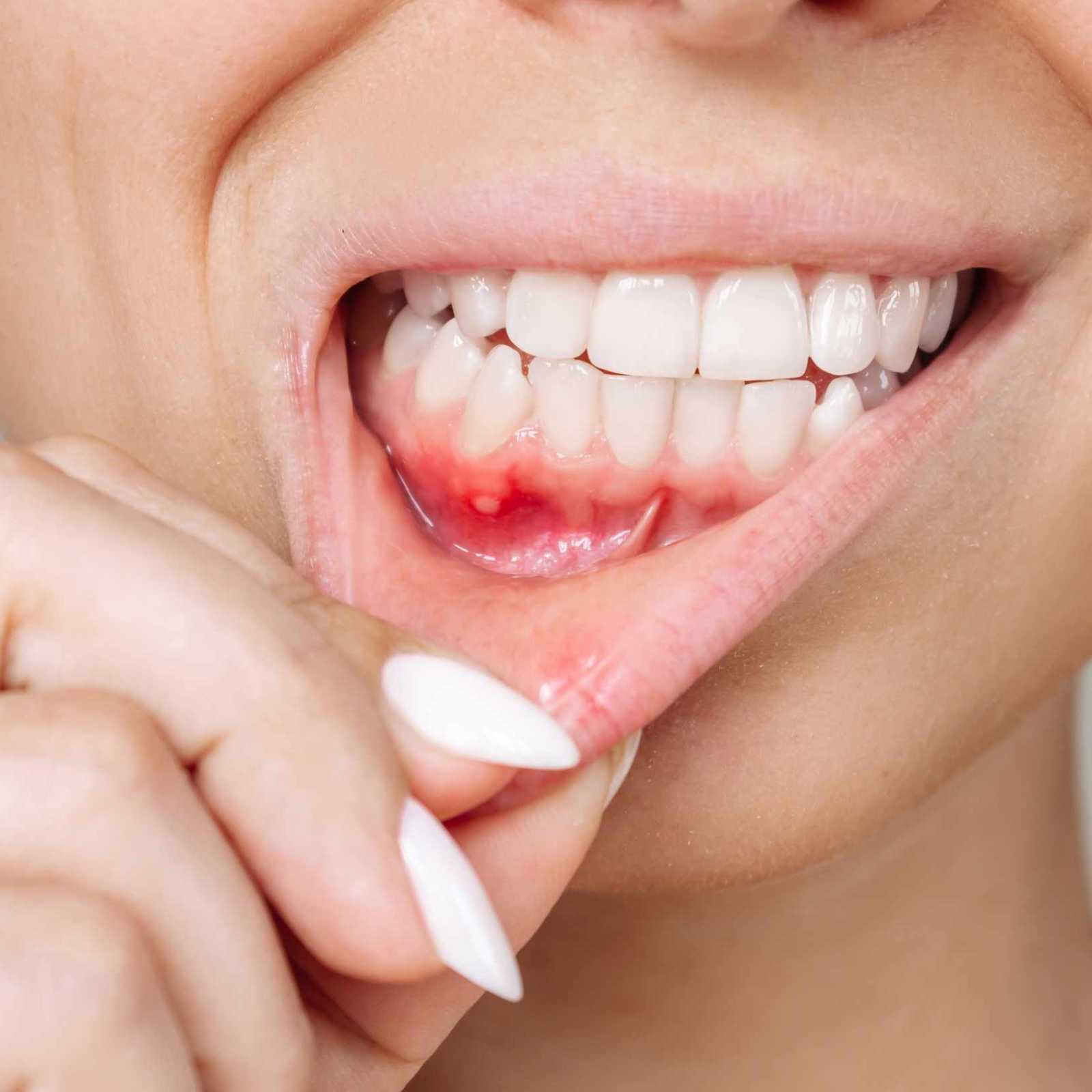 Tratamento de Aftas em Joinville