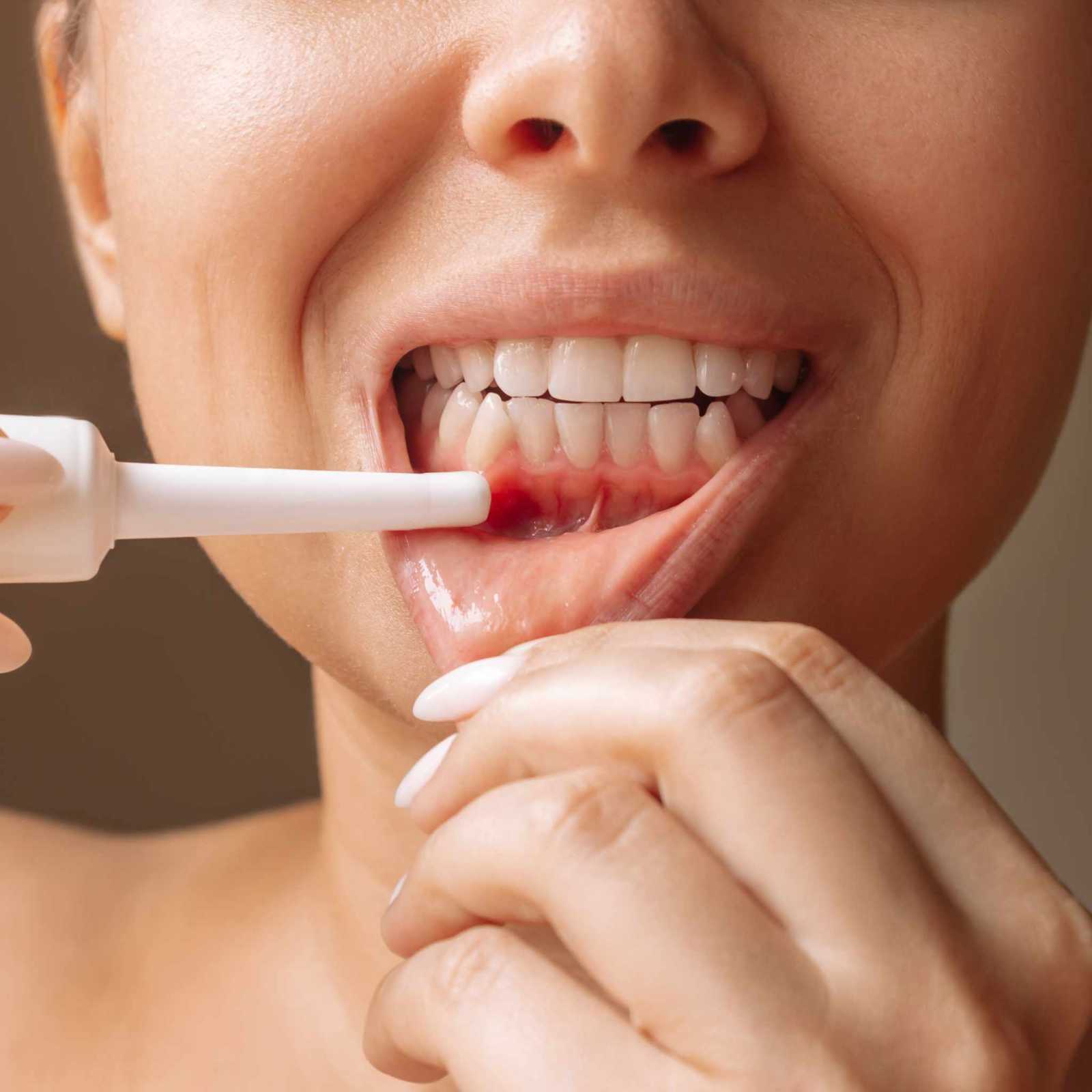 Tratamento de lesões bucais